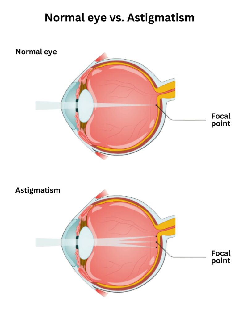 Astigmatism can be a genetic problem or caused by either injury or disease